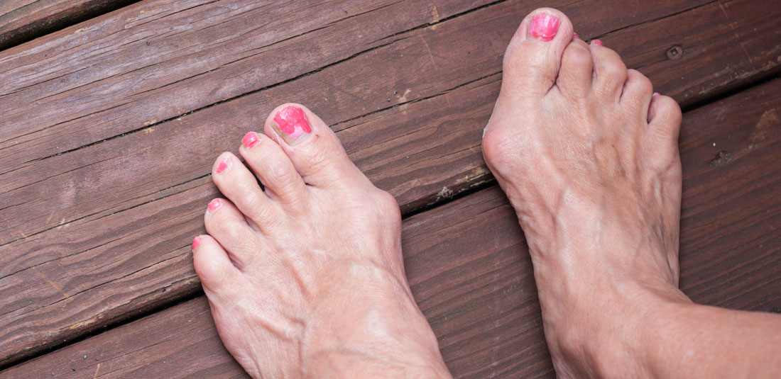 Biến dạng ngón chân cái là tình trạng của bệnh bunions